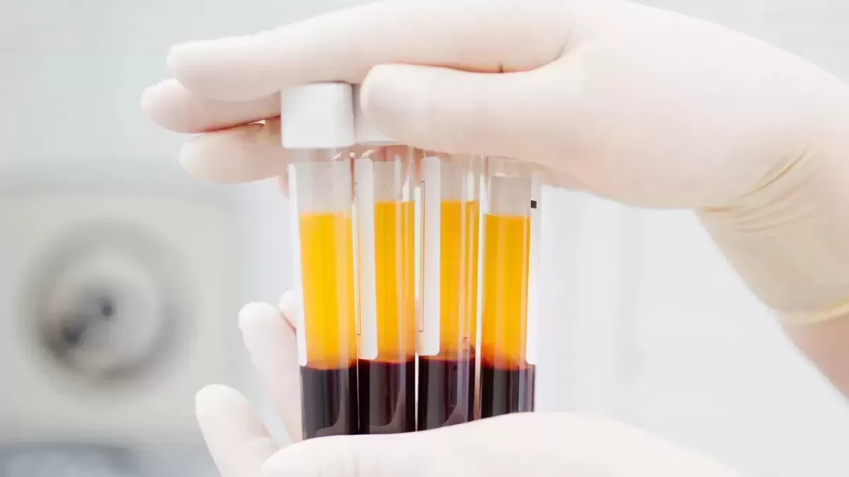 PRF-“Platelet-Rich Fibrin” 